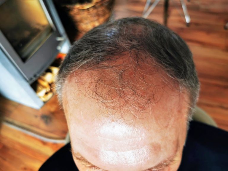 haartransplantation-vorher-mann-769x577.jpg