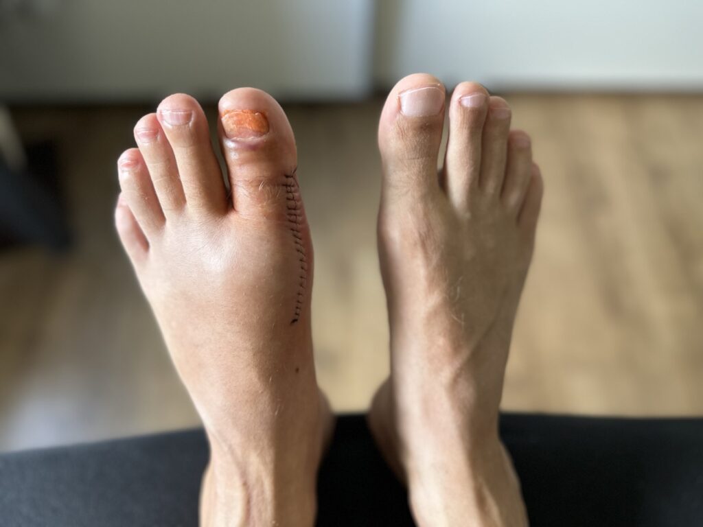 Hallux rigidus Narbe