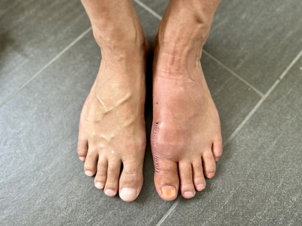 2 Wochen nach der Hallux rigidus OP ist der Fuß noch immer leicht geschwollen